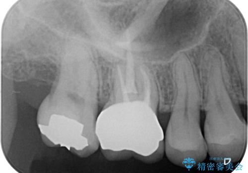 不適な樹脂の詰め物 被せ物で被覆の治療後