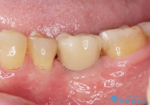 インプラントによる咬合機能回復の治療後