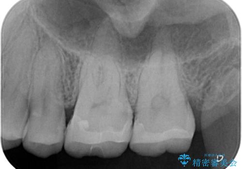 【メタルフリー】セラミックインレーの修復の治療後