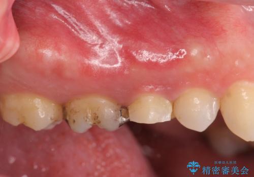 強い咬合力クリアランスの問題を解決したメタルボンドブリッジ治療の症例 治療前
