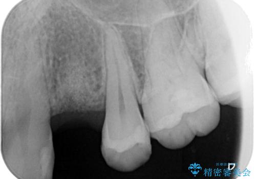 【インプラント】歯が無いので入れて欲しい!の治療中