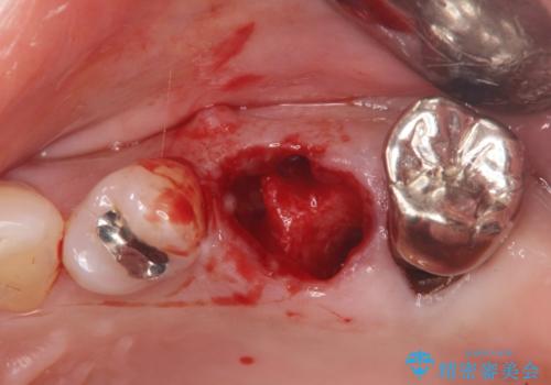 歯槽堤保存を行ったブリッジ治療の治療中