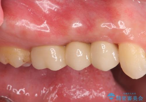 強い咬合力クリアランスの問題を解決したメタルボンドブリッジ治療の症例 治療後