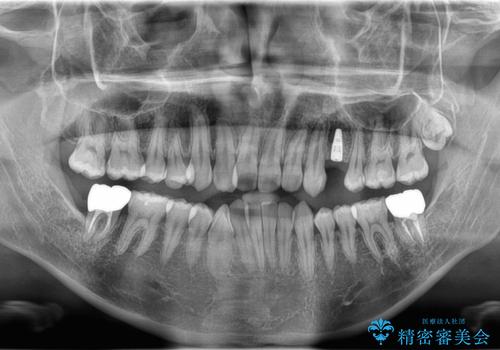 【インプラント】歯が無いので入れて欲しい!の治療後