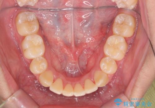 前歯のがたつき 下の八重歯の治療後