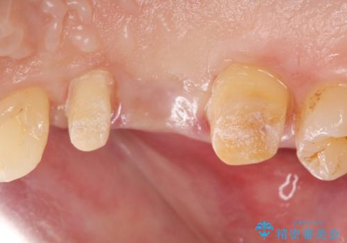 強い咬合力クリアランスの問題を解決したメタルボンドブリッジ治療の治療中