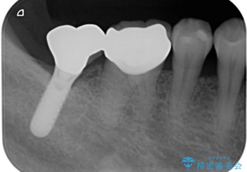 虫歯の治療　できれば歯の向きも変えたいの治療後