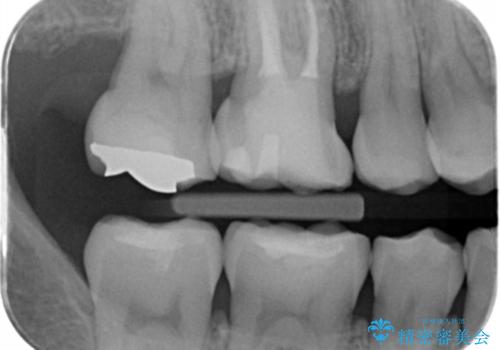 不適な樹脂の詰め物 被せ物で被覆の治療前
