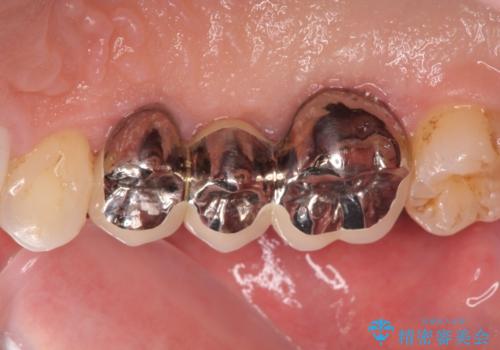 クリアランスの問題を解決したブリッジ治療の治療後