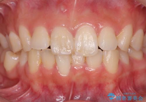 [ 前歯のセラミック治療 ]  変色した前歯を綺麗にしたいの治療前