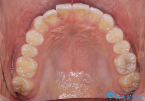 前歯のがたつき 1年かからず治療 マウスピース矯正の治療後