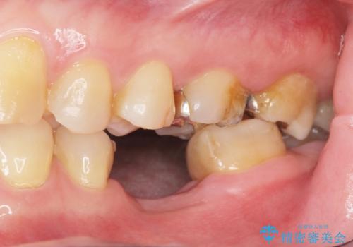 インプラントによる咬合機能回復の治療前
