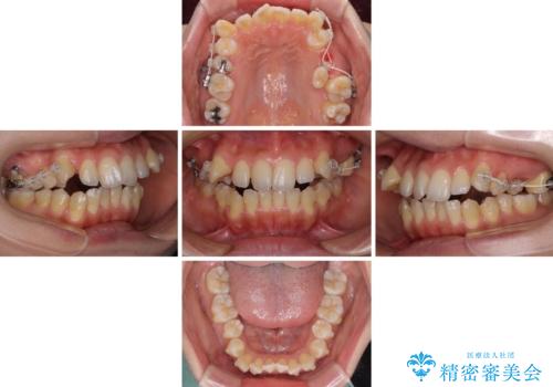 残存乳歯とオープンバイト インビザラインによる矯正治療の治療中