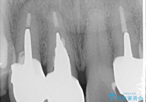 【オールセラミッククラウン】被せ物の色が気になる!の治療後