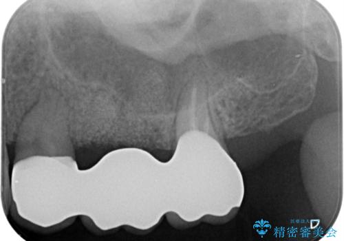 歯槽堤保存を行ったブリッジ治療の治療後