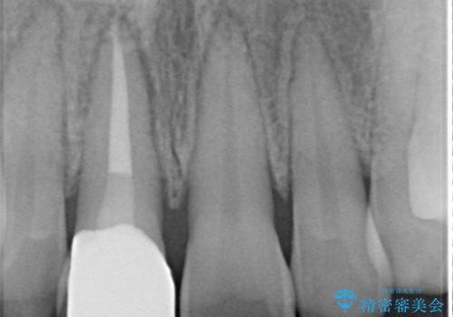 前歯の色が気になる オールセラミッククラウン(SP)の治療後