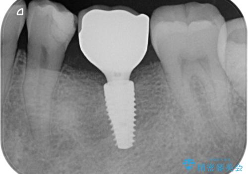 インプラントによる咬合機能回復の治療後