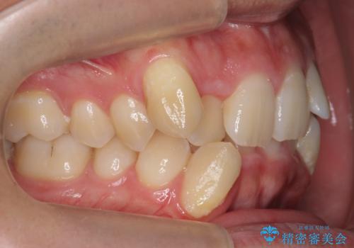 前歯のがたつき　下の八重歯の治療前