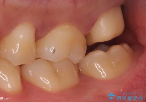 歯ぐきの形を整え、外れにくい被せ物を装着の治療中