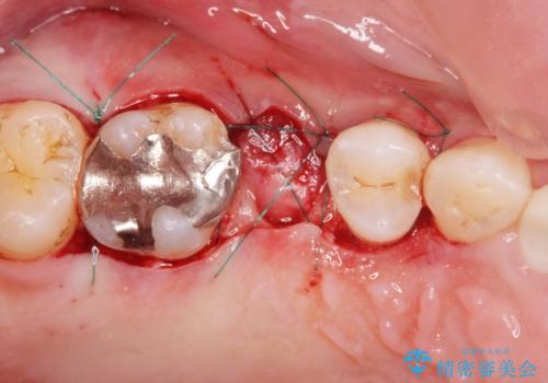 強い咬合力クリアランスの問題を解決したメタルボンドブリッジ治療の治療前