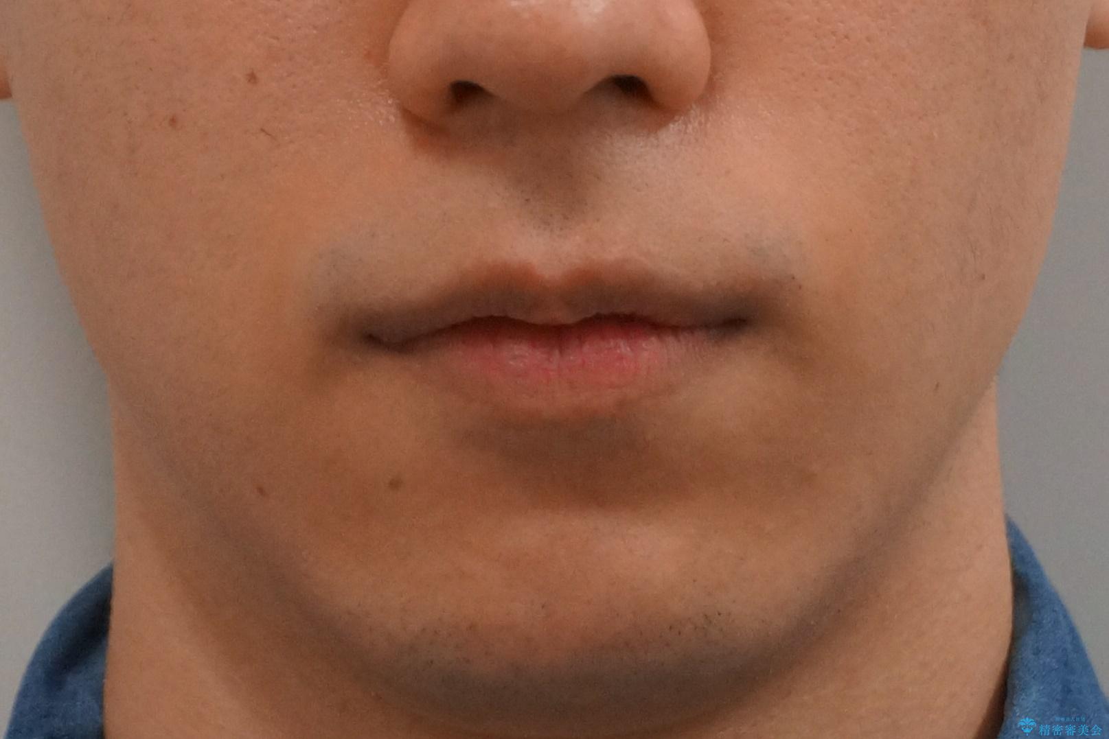 前歯のがたつき 下の八重歯の治療前(顔貌)