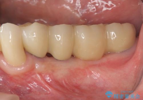 [ 重度歯周病 ]　抜歯後のインプラント治療の治療後