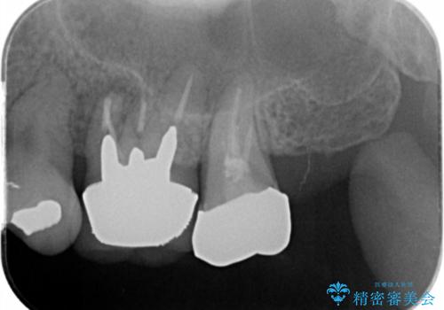 歯槽堤保存を行ったブリッジ治療の治療前