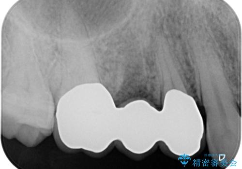 強い咬合力クリアランスの問題を解決したメタルボンドブリッジ治療の治療後