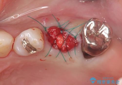 歯槽堤保存を行ったブリッジ治療の治療中