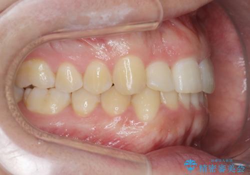 前歯が隠れていて見えない クロスバイトの矯正治療の治療後