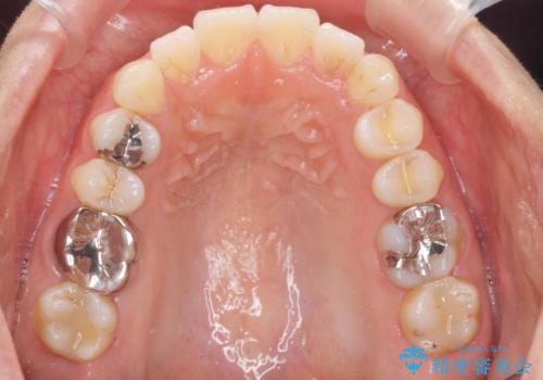 前歯の角度を改善するマウスピース矯正の治療後