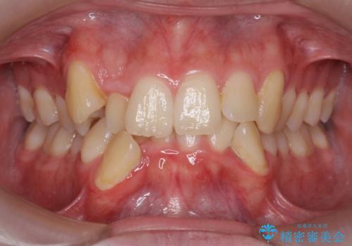 前歯のがたつき　下の八重歯の症例 治療前