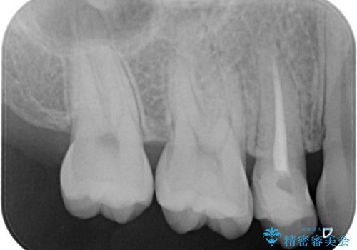 【根管治療歯の補綴】インレーからクラウンへの治療前