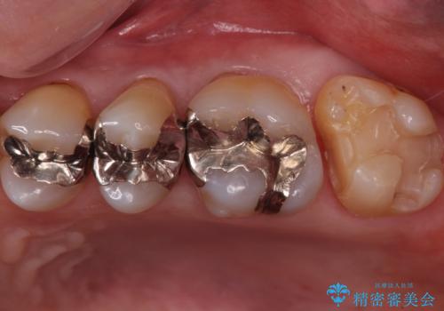 奥歯の虫歯　ゴールドインレーでの修復処置の治療中