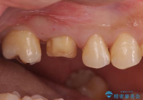 不適な樹脂の詰め物 被せ物で被覆の治療中