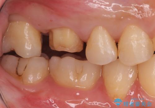 不適な樹脂の詰め物 被せ物で被覆の治療中