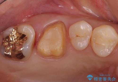 不適な樹脂の詰め物 被せ物で被覆の治療中