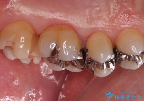 奥歯の虫歯 ゴールドインレーでの修復処置の治療中