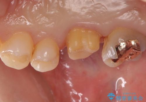 不適な樹脂の詰め物 被せ物で被覆の治療中