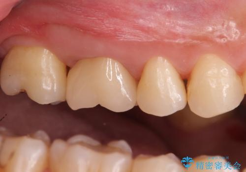 不適な樹脂の詰め物 被せ物で被覆の治療後