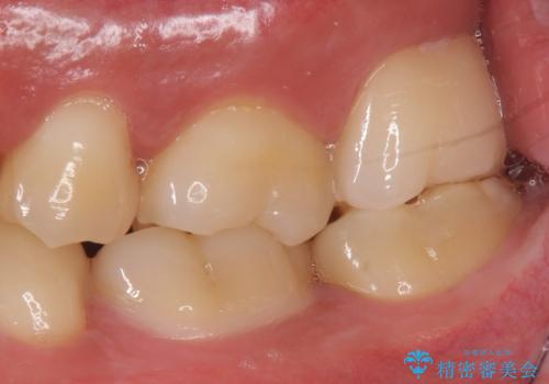 歯ぐきの形を整え、外れにくい被せ物を装着の治療後