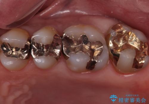 奥歯の虫歯　ゴールドインレーでの修復処置の症例 治療後