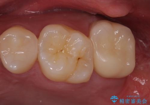 歯ぐきの形を整え、外れにくい被せ物を装着の治療後