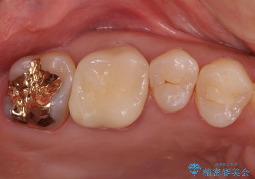 不適な樹脂の詰め物　被せ物で被覆の症例 治療後