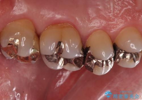 奥歯の虫歯 ゴールドインレーでの修復処置の治療後