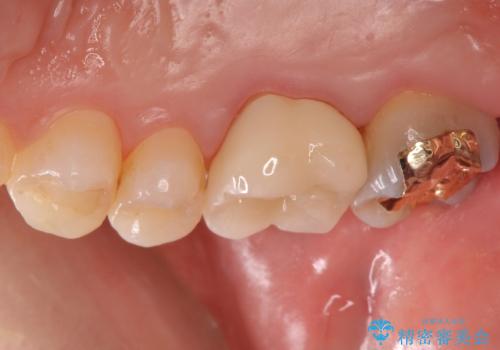 不適な樹脂の詰め物 被せ物で被覆の治療後