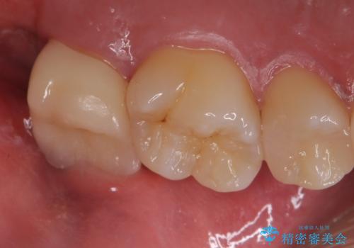 歯ぐきの形を整え、外れにくい被せ物を装着の治療後