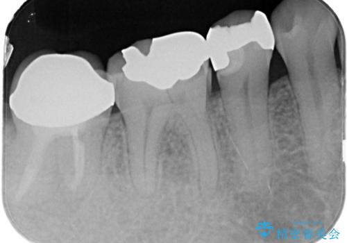 【インプラント】食事中に歯が割れた! かなり深いところまで歯が割れていたの治療前