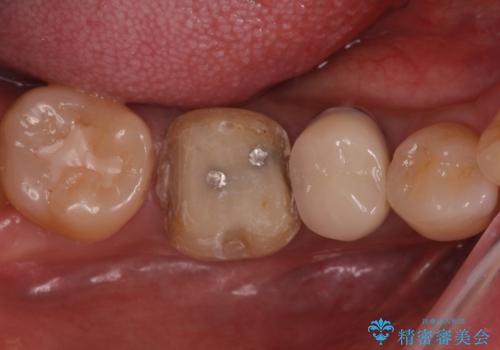 目立つ銀歯を白くしたい ジルコニアクラウンでの修復の治療中