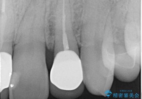 前歯を綺麗にしたい。 ジルコニアクラウンでの修復の治療後